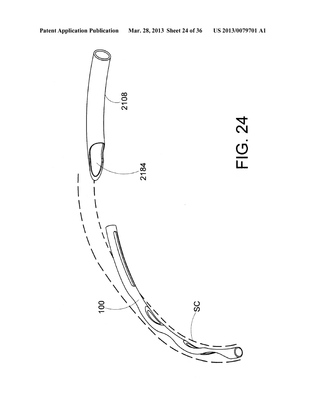 Methods and Apparatus for Delivering Ocular Implants Into the Eye - diagram, schematic, and image 25