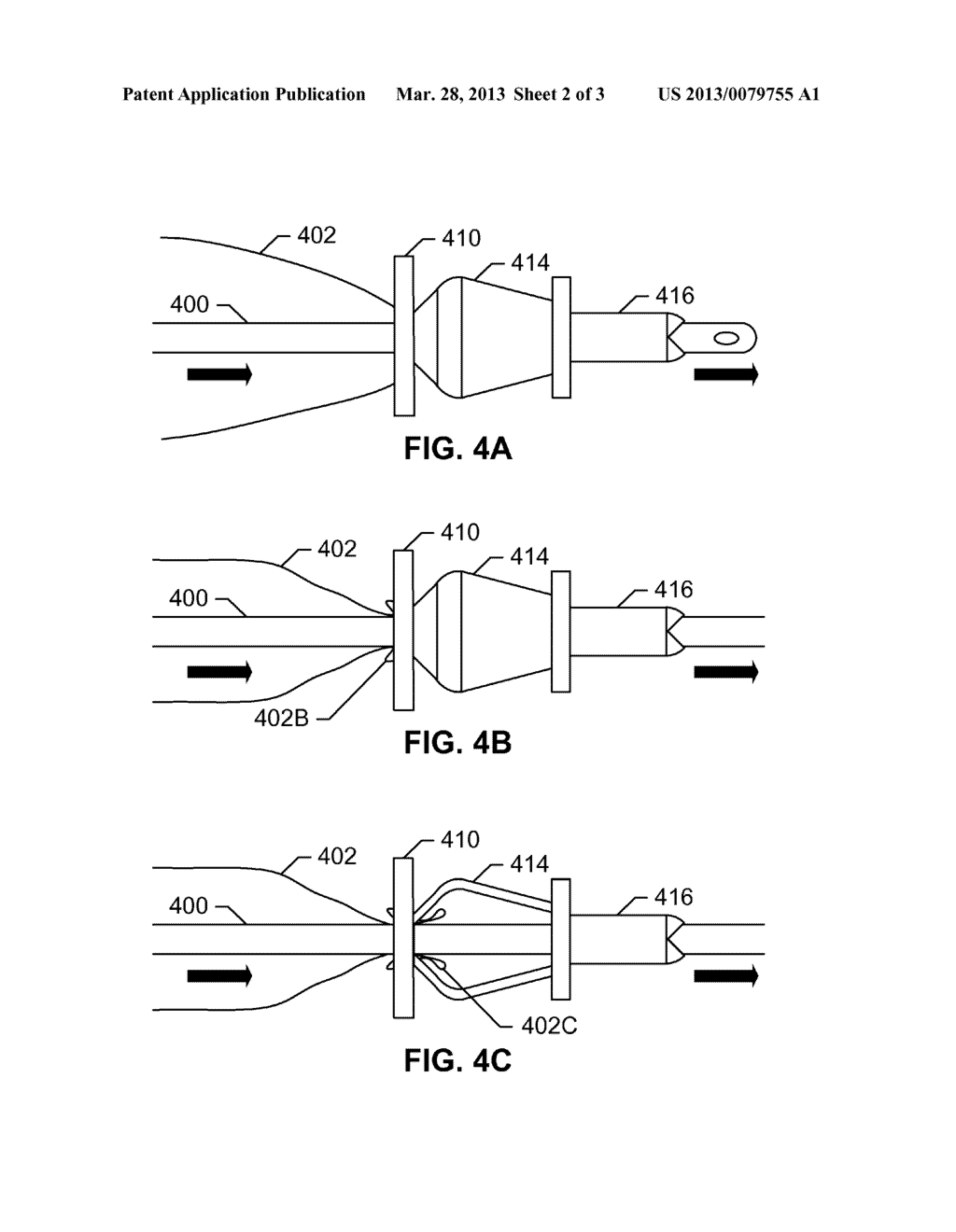 Catheter Advancement - diagram, schematic, and image 03