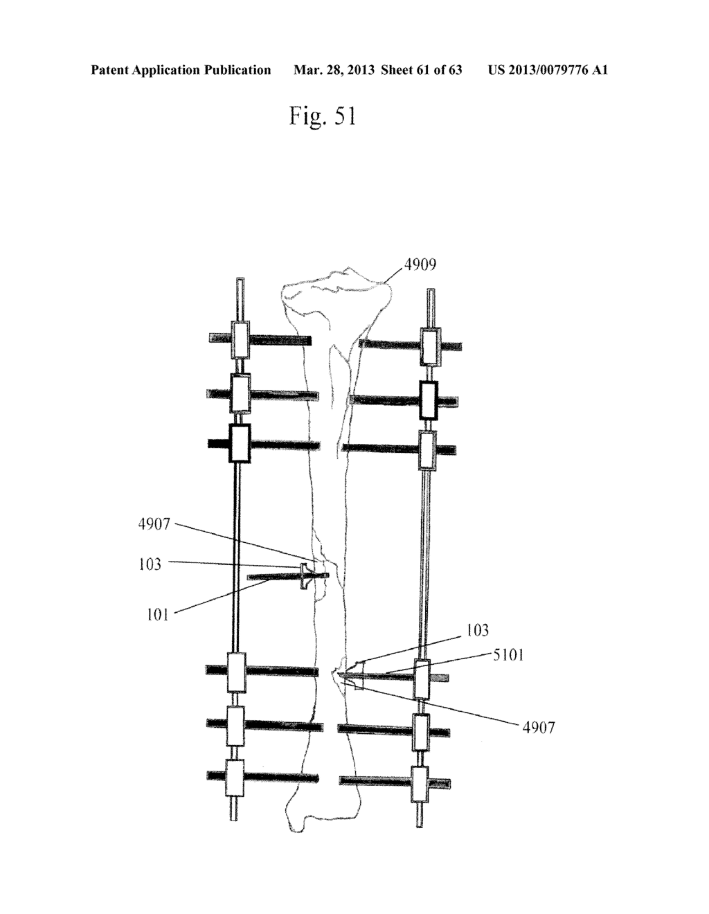 BONE COMPRESSION SYSTEM - diagram, schematic, and image 62