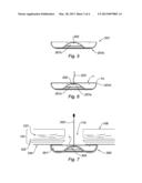 PROTHESIS COMPRISING A REINFORCED MESH diagram and image