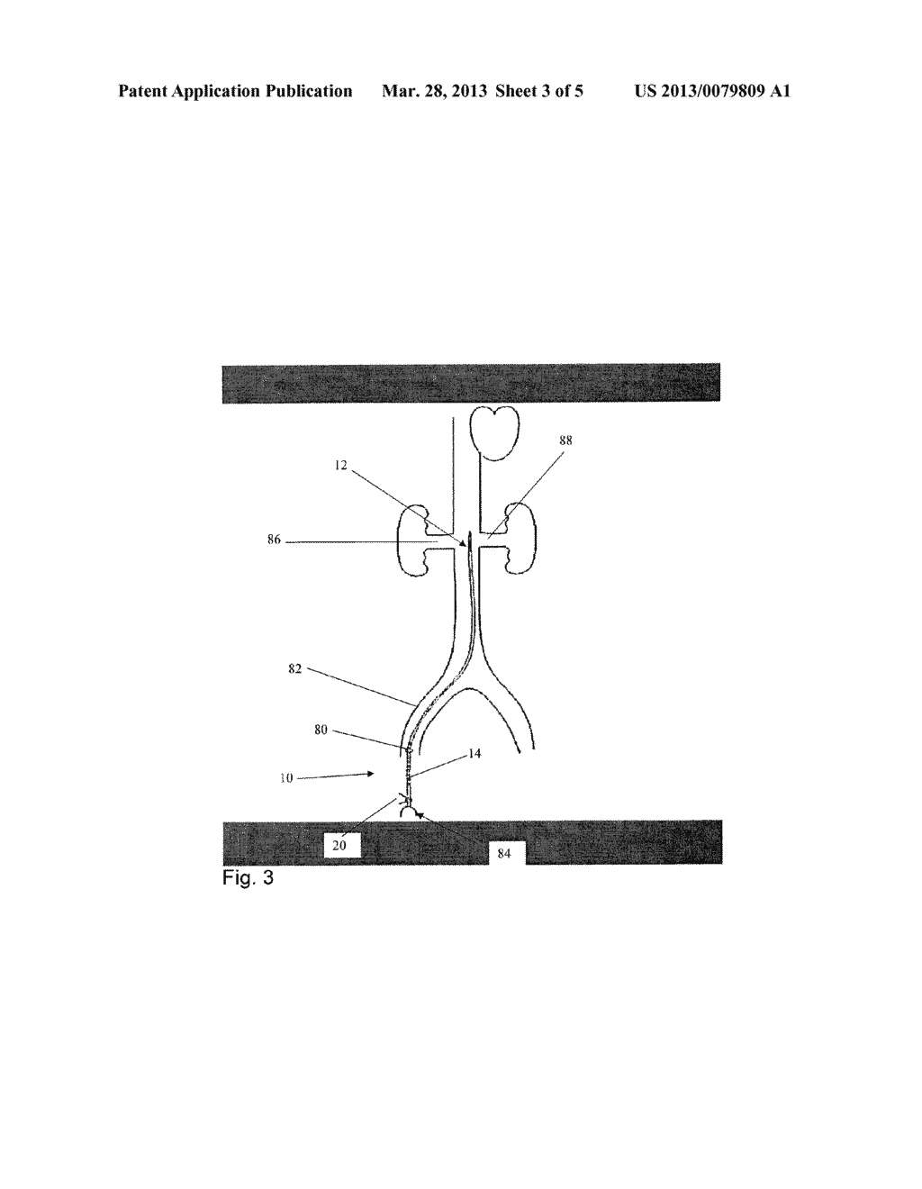 INTRODUCER PLACEMENT SYSTEM - diagram, schematic, and image 04