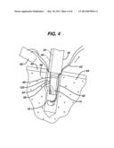 KNOTLESS SUTURE ANCHOR diagram and image