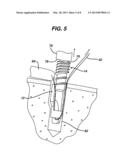 KNOTLESS SUTURE ANCHOR diagram and image