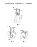 SUTURE ANCHOR diagram and image