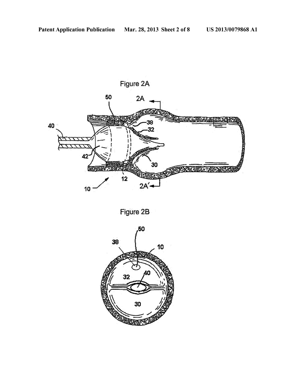 METHODS OF REDUCING RETROGRADE FLOW - diagram, schematic, and image 03