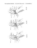 STENT FOR THE POSITIONING AND ANCHORING OF A VALVULAR PROSTHESIS IN AN     IMPLANTATION SITE IN THE HEART OF A PATIENT diagram and image