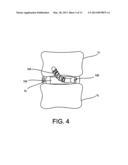 Flexible Anchoring and Fusion Devices and Methods of Using the Same diagram and image