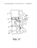 Flexible Anchoring and Fusion Devices and Methods of Using the Same diagram and image