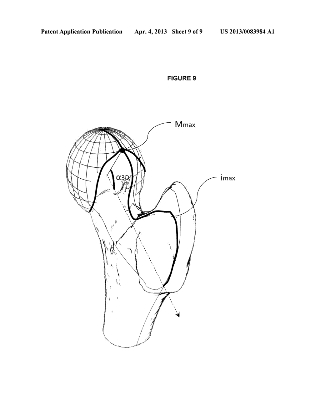 METHOD AND SYSTEM OF AUTOMATIC DETERMINATION OF GEOMETRIC ELEMENTS     CHARACTERIZING A BONE DEFORMATION FROM 3D IMAGE - diagram, schematic, and image 10