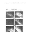 DIAGNOSIS AND PREVENTION OF CANCER CELL INVASION diagram and image