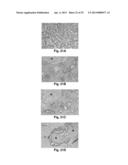 MicroRNA-Based Methods and Compositions for the Diagnosis, Prognosis and     Treatment of Prostate Related Disorders diagram and image