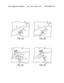 METHODS AND DEVICES FOR MANIPULATING TISSUE IN VIVO diagram and image