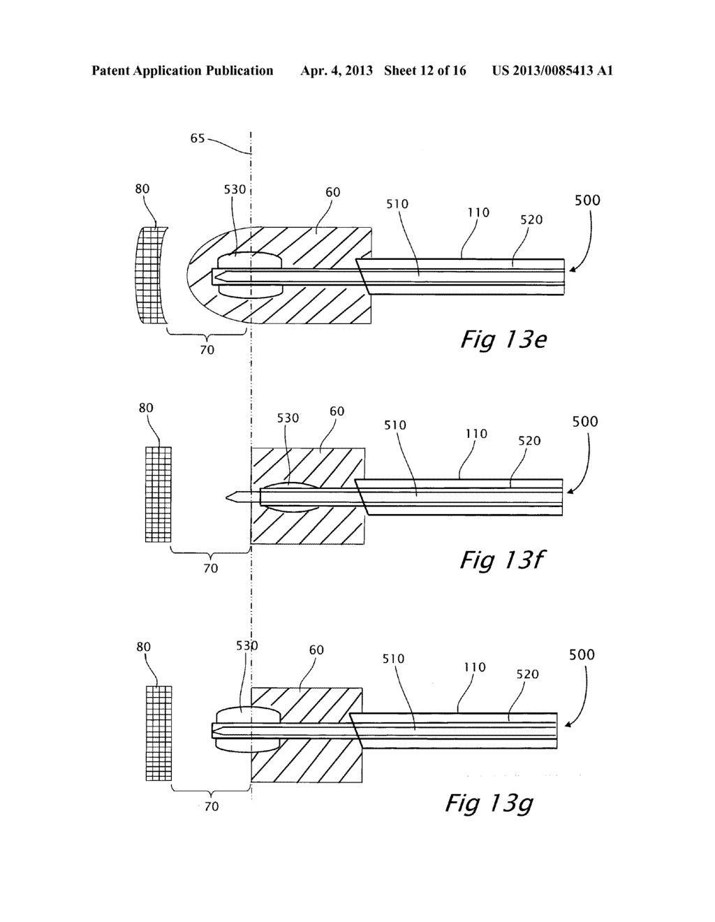 ANATOMICAL-POSITIONING APPARATUS AND METHOD WITH AN EXPANDABLE DEVICE - diagram, schematic, and image 13