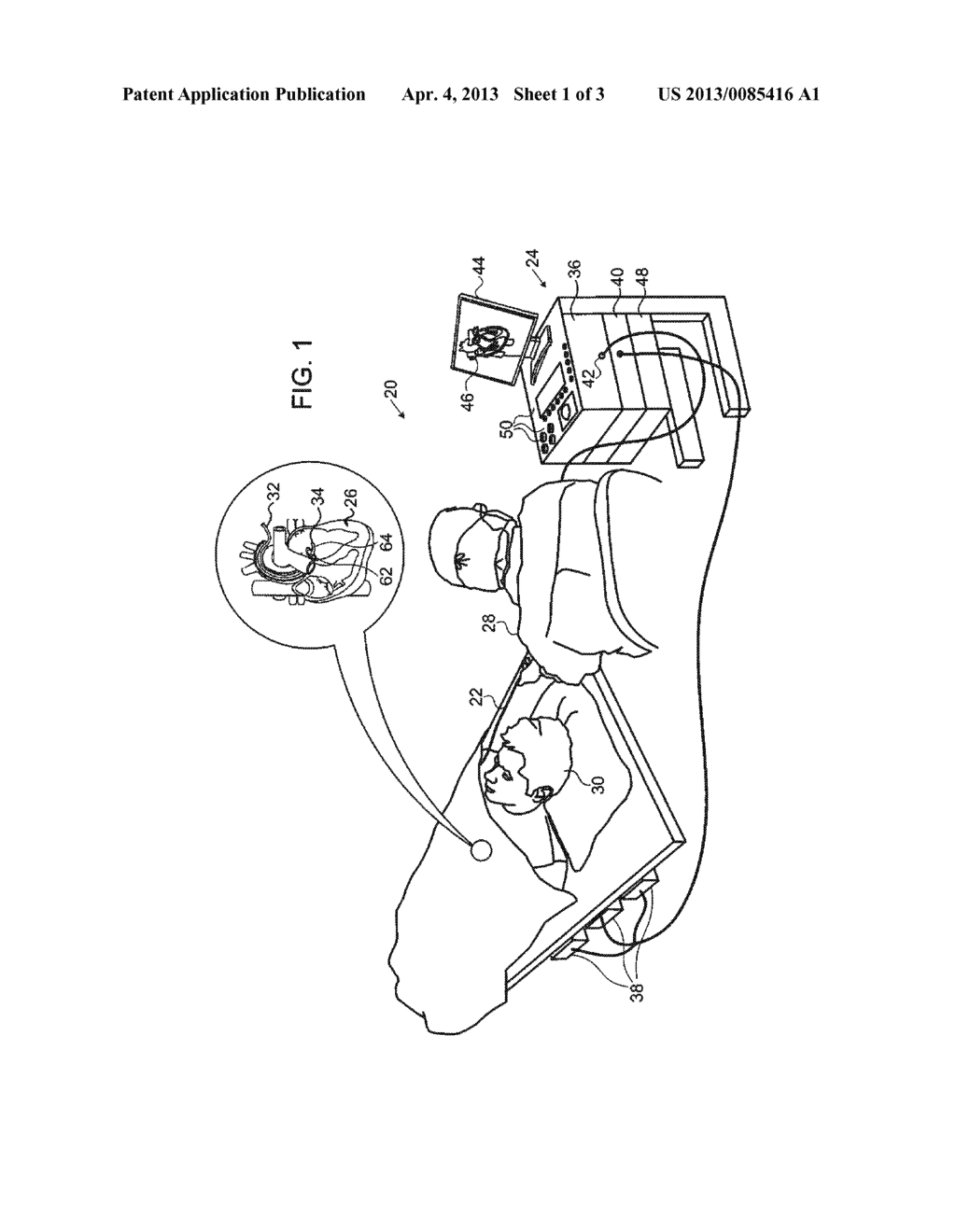 IN-VIVO CALIBRATION OF CONTACT FORCE-SENSING CATHETERS USING AUTO ZERO     ZONES - diagram, schematic, and image 02