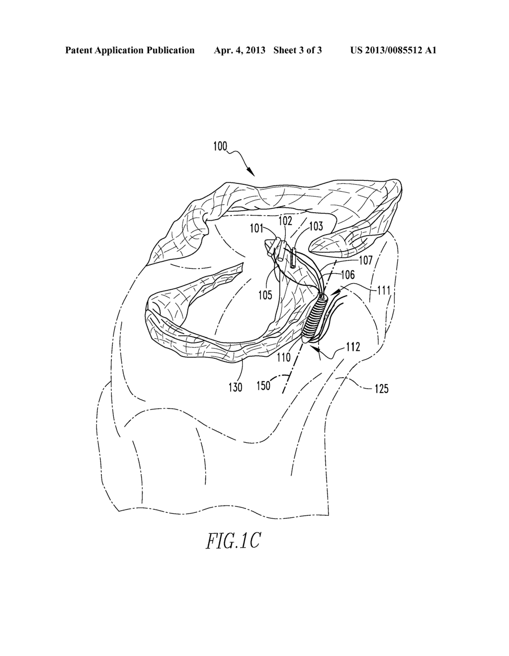 MENISCAL ROOT ATTACHMENT REPAIR - diagram, schematic, and image 04