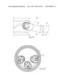 ATHERECTOMY DEVICES AND METHODS diagram and image