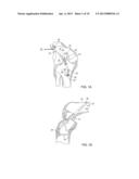 ATTACHMENT DEVICE TO ATTACH TISSUE GRAFT diagram and image