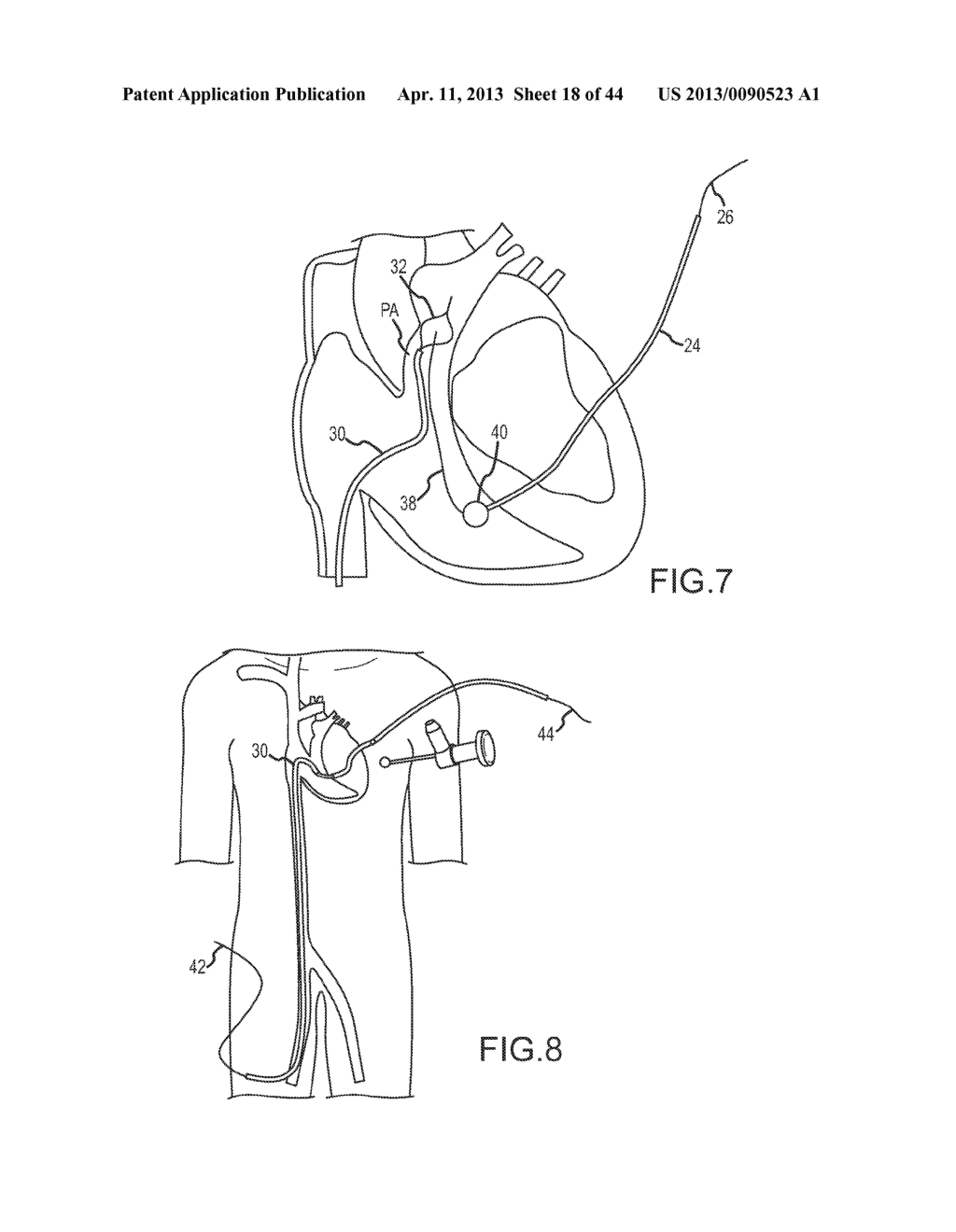 REMOTE PERICARDIAL HEMOSTASIS FOR VENTRICULAR ACCESS AND RECONSTRUCTION OR     OTHER ORGAN THERAPIES - diagram, schematic, and image 19