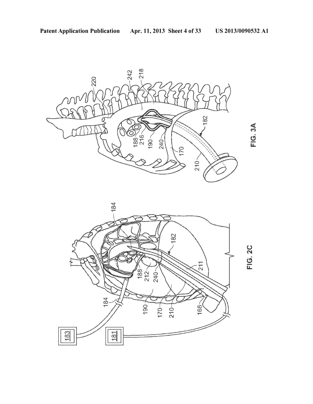 DIAPHRAGM ENTRY FOR POSTERIOR SURGICAL ACCESS - diagram, schematic, and image 05