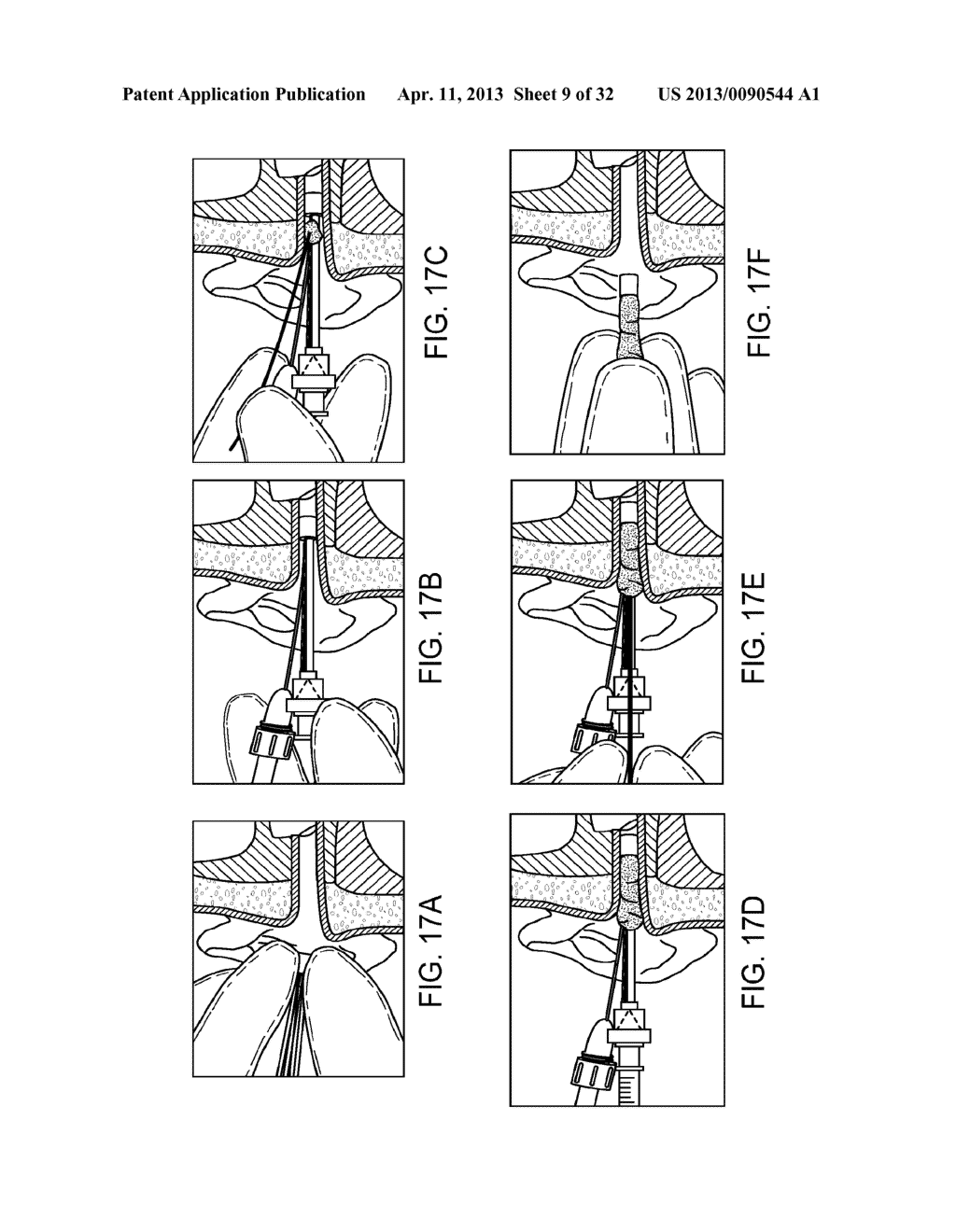 SYSTEM AND METHOD FOR THE SIMULTANEOUS BILATERAL TREATMENT OF TARGET     TISSUES WITHIN THE EARS USING A GUIDE BLOCK STRUCTURE - diagram, schematic, and image 10