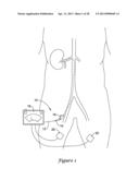 DEVICE AND METHODS FOR RENAL NERVE MODULATION diagram and image