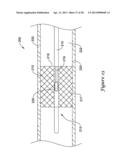 DEVICE AND METHODS FOR RENAL NERVE MODULATION diagram and image