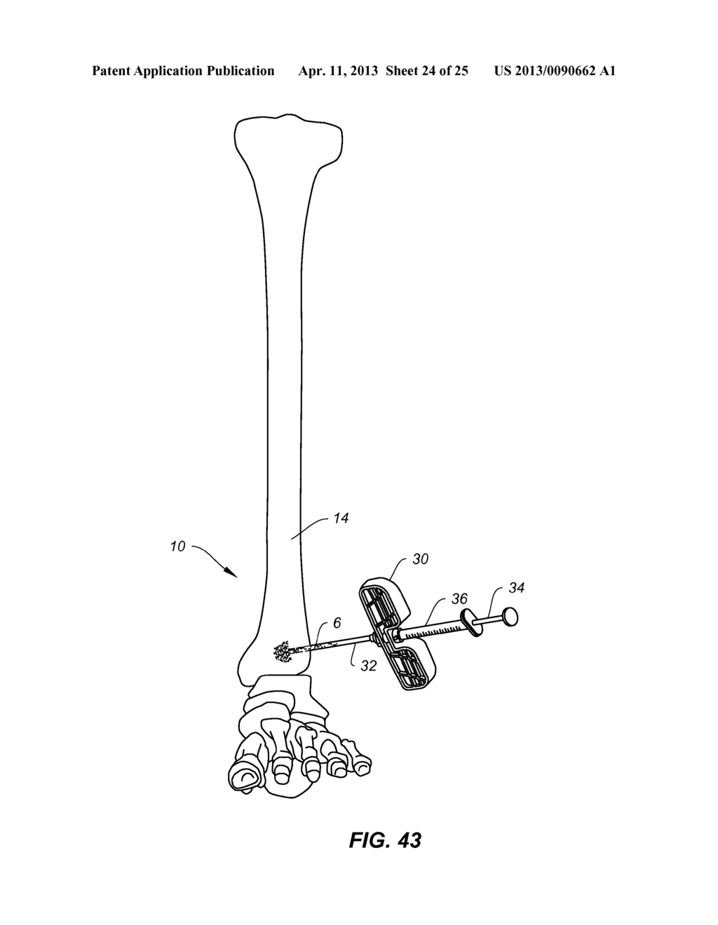 METHODS AND INSTRUMENTS FOR SUBCHONDRAL TREATMENT OF OSTEOARTHRITIS IN A     SMALL JOINT - diagram, schematic, and image 25