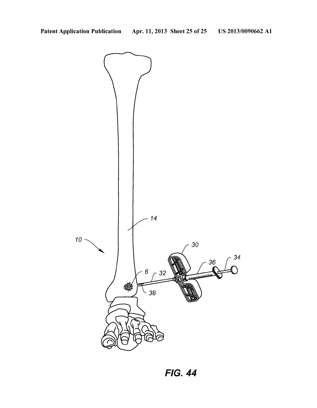 METHODS AND INSTRUMENTS FOR SUBCHONDRAL TREATMENT OF OSTEOARTHRITIS IN A     SMALL JOINT - diagram, schematic, and image 26
