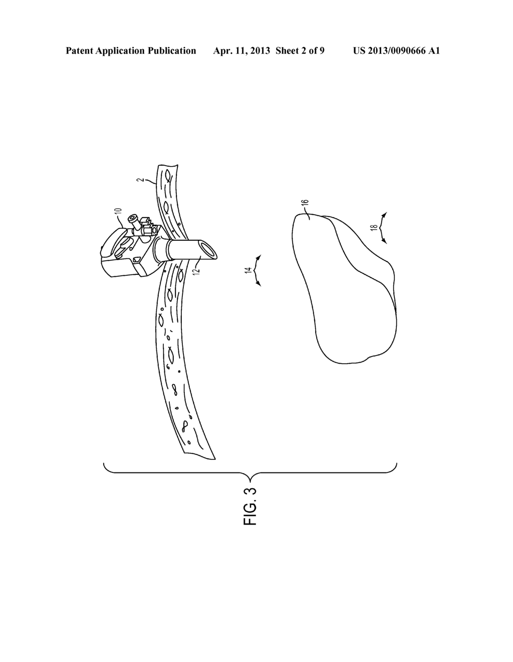 VACUUM ASSISTED TISSUE MANIPULATION DEVICES AND SURGICAL METHODS - diagram, schematic, and image 03