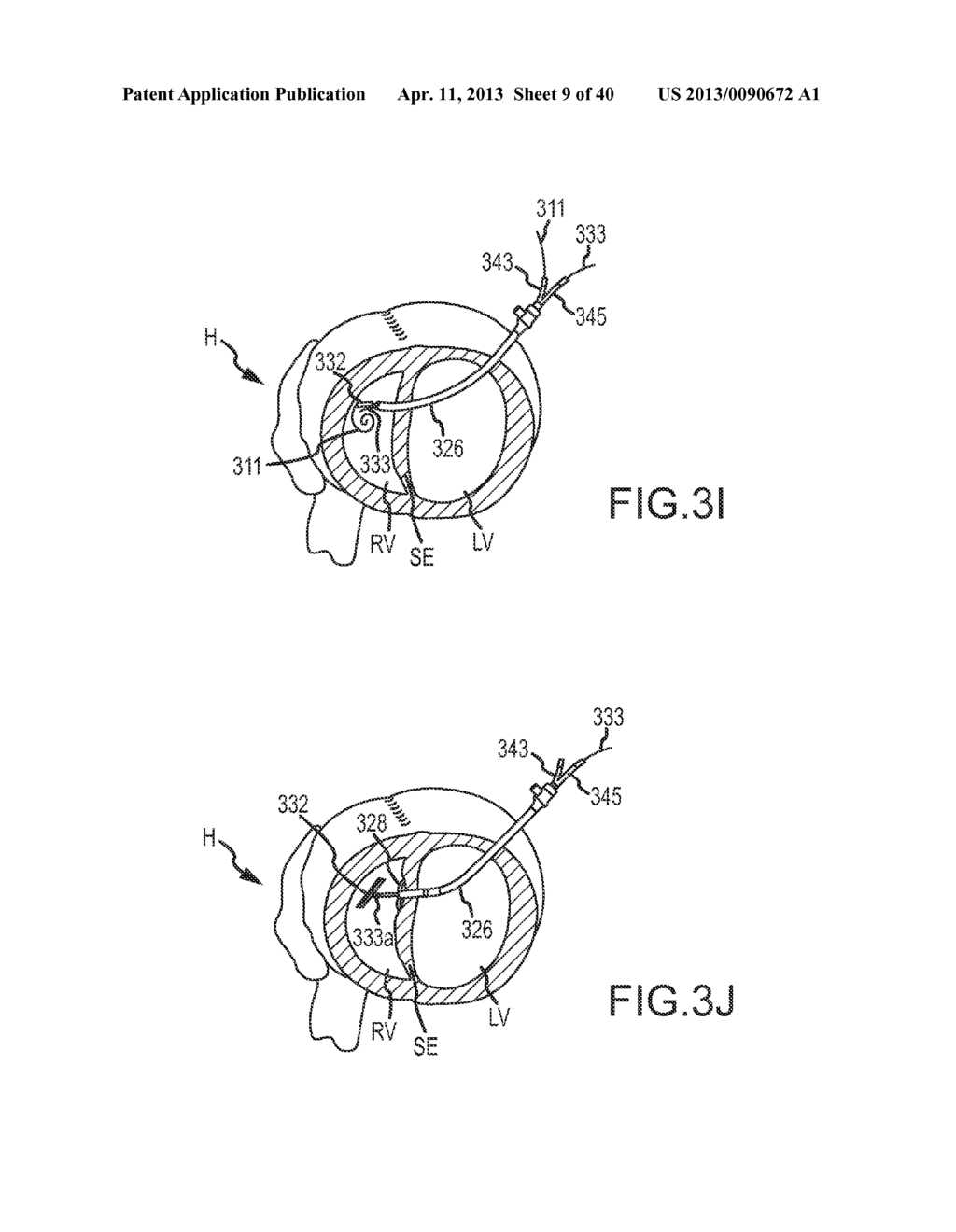 CARDIAC IMPLANT MIGRATION INHIBITING SYSTEMS - diagram, schematic, and image 10