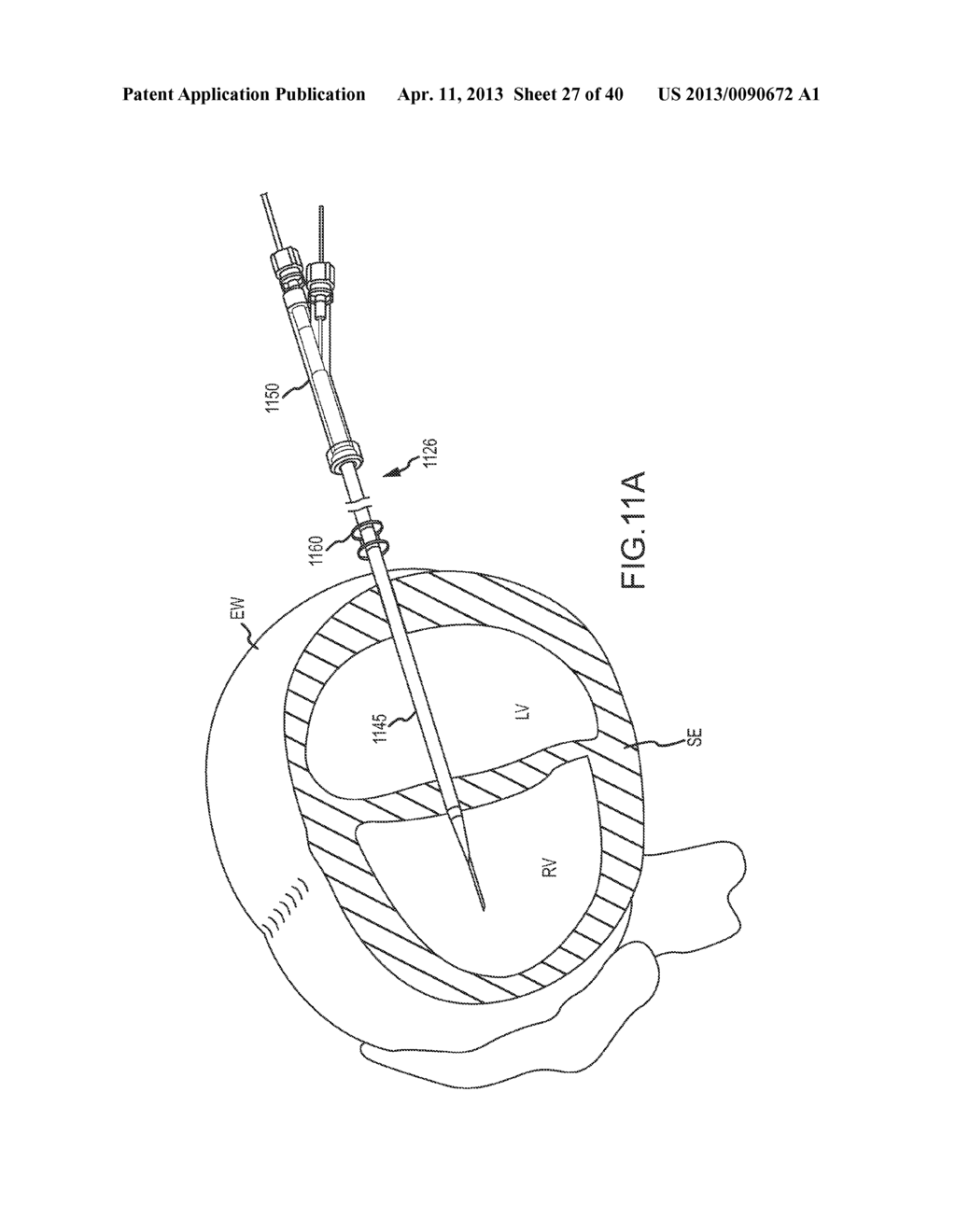 CARDIAC IMPLANT MIGRATION INHIBITING SYSTEMS - diagram, schematic, and image 28