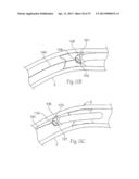 ATHERECTOMY DEVICES AND METHODS diagram and image