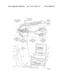 Operating A Vessel Occlusion Catheter diagram and image