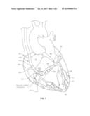 Operating A Vessel Occlusion Catheter diagram and image