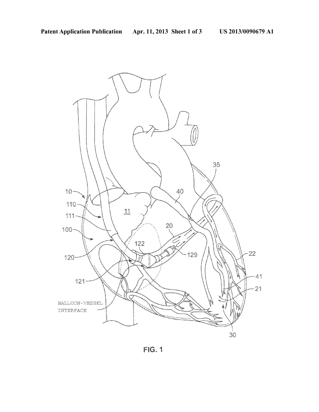 Operating A Vessel Occlusion Catheter - diagram, schematic, and image 02