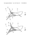 DEVICES, SYSTEMS AND METHODS FOR ENCLOSING AN ANATOMICAL OPENING diagram and image