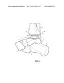 IMPLANTABLE ANKLE JOINT ASSEMBLY WITH SPHERICAL INTER-SUPPORT diagram and image