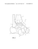 IMPLANTABLE ANKLE JOINT ASSEMBLY WITH SPHERICAL INTER-SUPPORT diagram and image