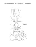 IMPLANTABLE ANKLE JOINT ASSEMBLY WITH SPHERICAL INTER-SUPPORT diagram and image