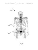 SYSTEM FOR DETECTING BONE CANCER METASTASES diagram and image