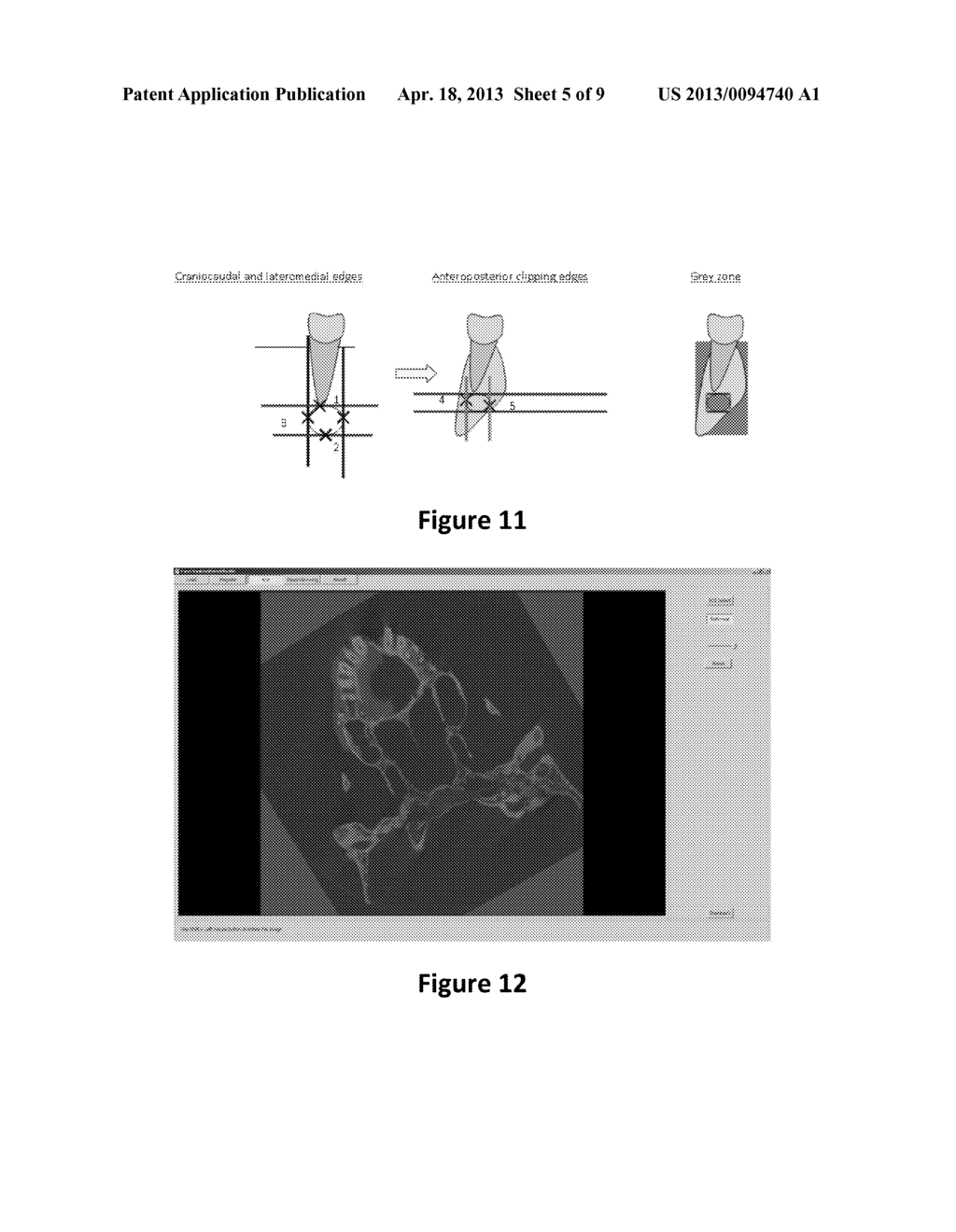 METHOD FOR QUANTIFYING LOCAL BONE CHANGES - diagram, schematic, and image 06