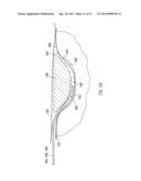 WOUND FILLING APPARATUSES AND METHODS diagram and image