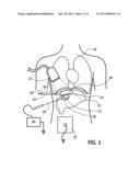 Hydrodissection Material with Reduced Migration diagram and image