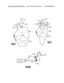 TOTAL JOINT INSTRUMENTATION AND METHOD FOR USE diagram and image