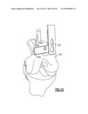 TOTAL JOINT INSTRUMENTATION AND METHOD FOR USE diagram and image