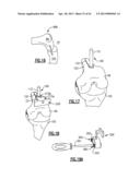 TOTAL JOINT INSTRUMENTATION AND METHOD FOR USE diagram and image