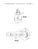 TOTAL JOINT INSTRUMENTATION AND METHOD FOR USE diagram and image