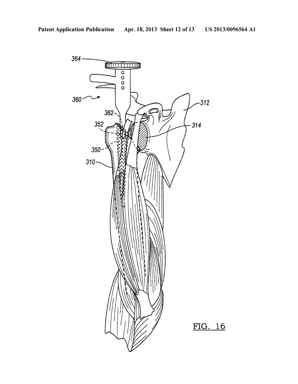 METHOD AND APPARATUS FOR PERFORMING A LESS INVASIVE SHOULDER PROCEDURE - diagram, schematic, and image 13