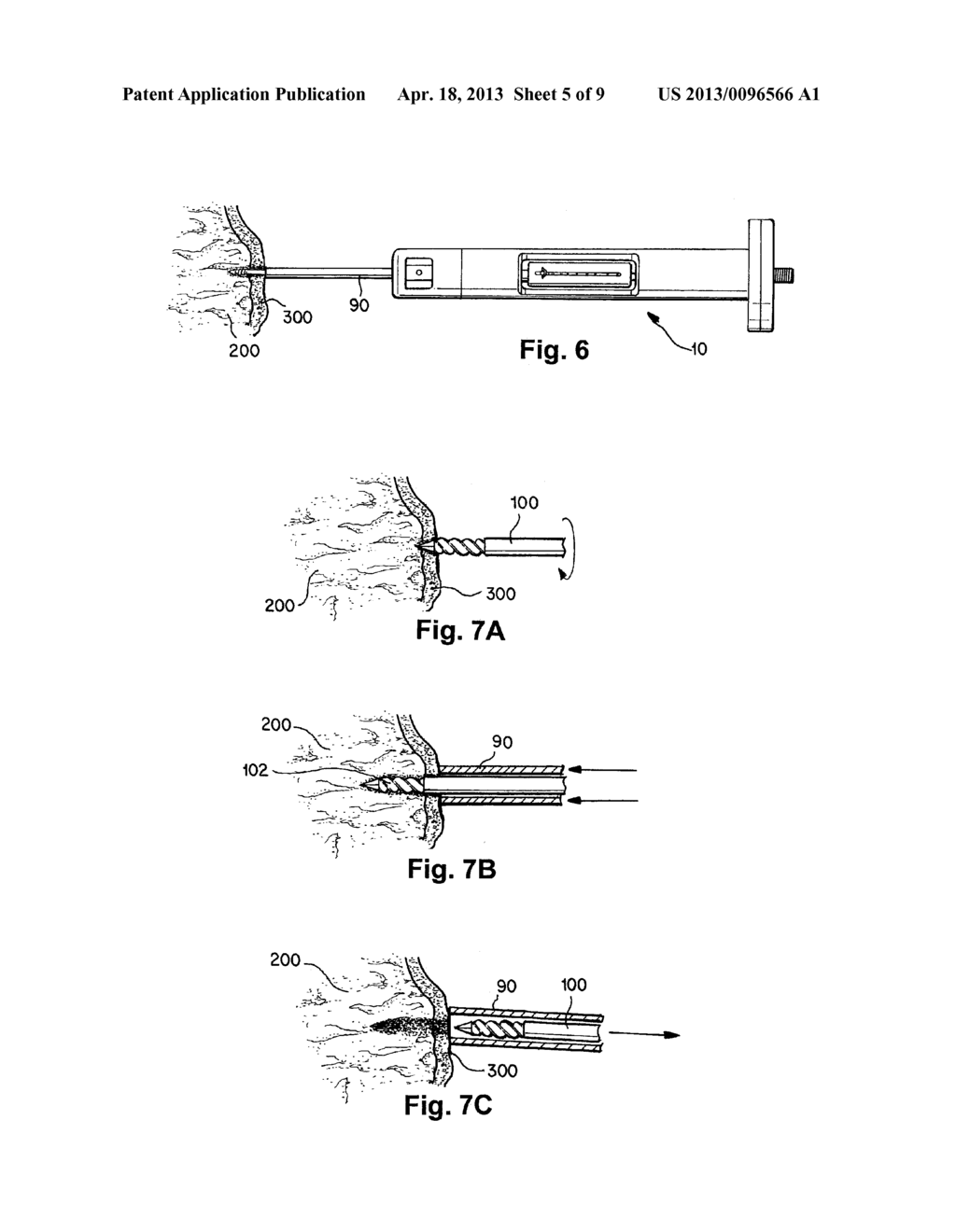 DIAGNOSTIC DEVICE FOR DETERMINING MECHANICAL INTEGRITY OF BONE - diagram, schematic, and image 06