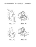 OVER-THE-WIRE CARDIAC IMPLANT DELIVERY SYSTEM FOR TREATMENT OF CHF AND     OTHER CONDITIONS diagram and image